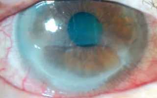 Эрозия глаза: чем лечить сетчатку глаза при травматической эрозии