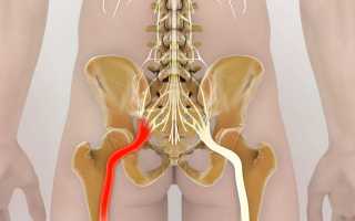 Ущемление нерва в поясничном отделе позвоночника