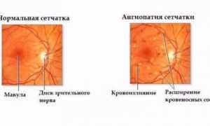 Ангиопатия сетчатки МКБ 10: гипертоническая дистрофия обоих глаз у ребенка