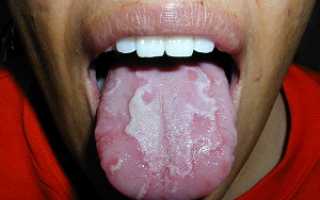 Воспалительное заболевание – глоссит языка: фото, комплексное лечение в клинике и в домашних условиях