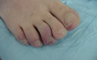Онемение пальцев ног