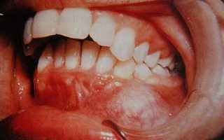 Опухоль челюстных костей – остеогенная саркома челюсти: симптомы и клинические проявления, способы лечения и возможные последствия