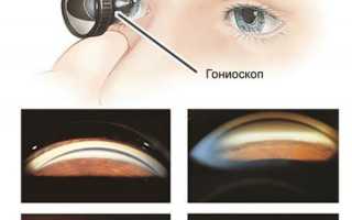 Пятно Фукса: синдром гетерохромии глаз в офтальмологии