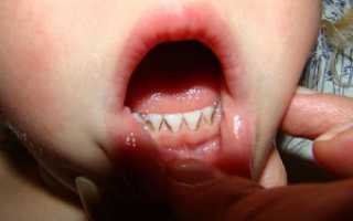 Почему появляется черный налет на зубах у детей: причины, методы лечения и возможные осложнения