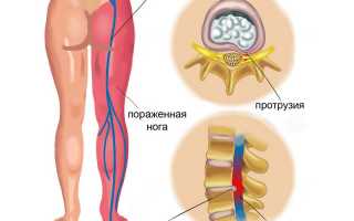 Болезни позвоночника