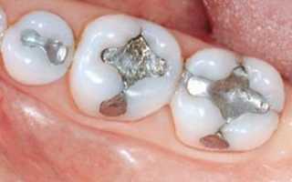 Какие лучше и как выбрать подходящую пломбу для зубов: виды материалов, характеристика и особенности процедуры пломбирования