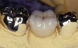 В каких случаях ставят коронки на зубы? – и как это происходит