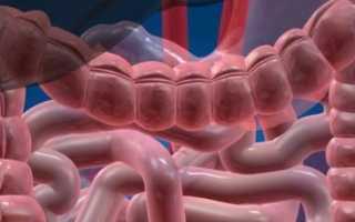 Что такое кишечный амебиаз и как его вылечить