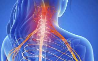Лечение корешкового синдрома шейного отдела