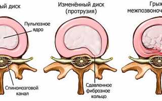 Лечение грыжи поясничного отдела позвоночника