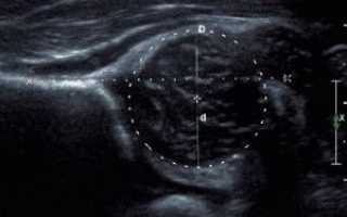 УЗИ тазобедренных суставов новорожденных