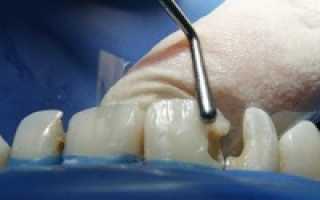 Аппаратное отбеливание зубов зумом: особенности проведения и результат после процедуры
