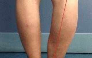 Лечение деформирующего артроза коленного сустава и его степени