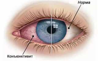 Красные белки глаз: причины и что делать при постоянном покраснении и воспалении глазного яблока
