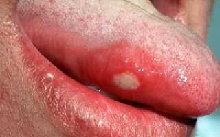 Почему болит язык сбоку: причины, чем лечить дискомфорт в полости рта, профилактические рекомендации