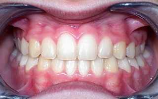 Как выглядит правильный и неправильный прикус зубов у детей и взрослых: признаки и виды аномалии, методы коррекции зубного ряда