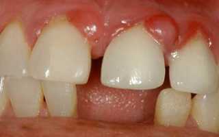 Гранулема зуба лечение таблетки