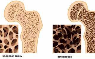 Можно ли вылечить остеопороз позвоночника?