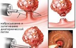 Может ли полип матки выйти с месячными – действовать или подождать?