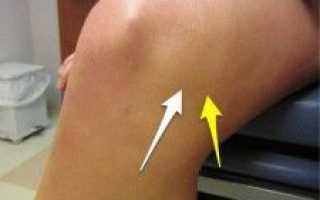 Повреждение мениска колена