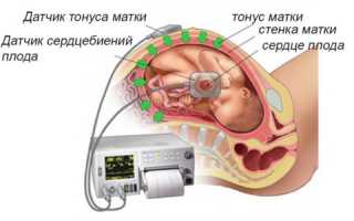 КТГ плода при беременности: зачем и как его делают