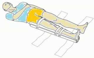 Что и как нужно фиксировать при переломе бедра