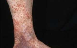 Последствия варикоза на ногах
