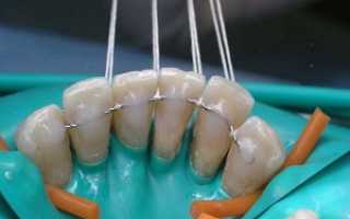 Процедура для укрепления зубного ряда – шинирование зубов: фото до и после, разновидности и результат