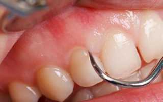 Как лечить воспаление десны около зуба в домашних условиях: эффективные народные средства и общая схема терапии