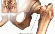 Можно ли сидеть при переломе шейки бедра
