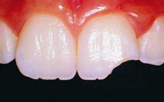 Причины и виды травмы или что делать, если откололся кусочек зуба: первая помощь и лечебные восстанавливающие процедуры
