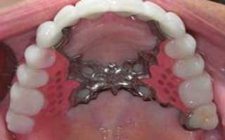 Современная конструкция для восстановления жевательной функции и эстетики зубного ряда – бюгельные протезы на верхнюю челюсть: фото и виды креплений