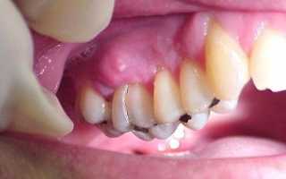 Периостит или воспаление надкостницы верхней челюсти: причины появления, методы лечения и возможные осложнения стоматологического заболевания
