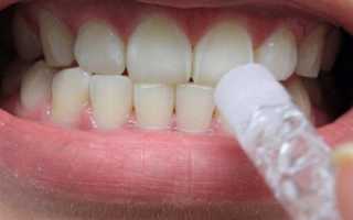 Как правильно пользоваться гелем для отбеливания зубов: секреты белоснежной улыбки и обзор популярных продуктов