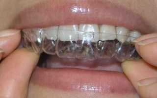 Помогают ли капы для выравнивания зубов? Цена, преимущества и недостатки ортодонтических конструкций
