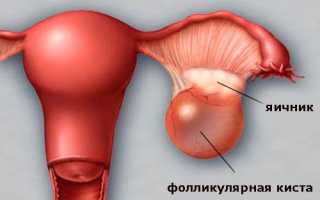 Гормональная киста яичника – причины появления, необходимость лечения, вероятность беременности