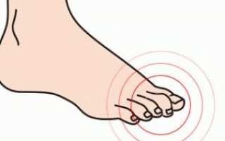 Деформация пальцев стопы