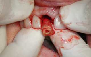 Чем и как удалить зуб без боли в домашних условиях: рекомендации и правила проведения процедуры, запрещенные действия