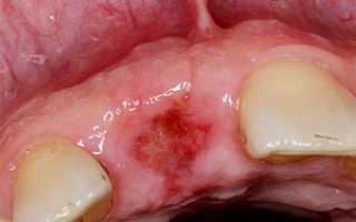 Последствия неправильнй резекции единицы зубного ряда – альвеолит после удаления зуба: симптомы, методы и правила лечения и профилактические меры