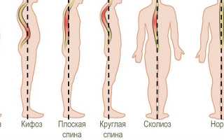 Спина Бифида у детей и взрослых