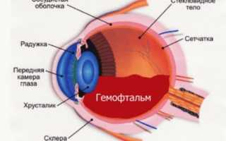 Гемофтальм код по МКБ 10: лечение левого и правого глаза у взрослых