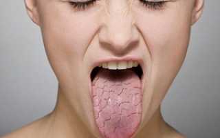 Ксеростомия или сухость во рту по ночам: причины и устранение неприятных симптомов, когда язык прилипает к небу