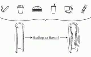 Облитерирующий атеросклероз артерий нижних конечностей