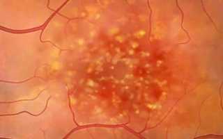 ПХРД сетчатки – ретинальные дегенерации обоих глаз при периферической витреохориоретинальной дистрофии