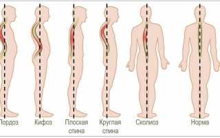 Лечение сколиоза у детей и подростков