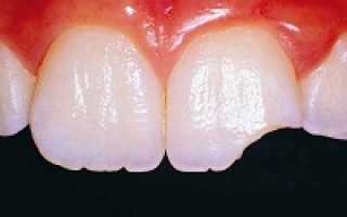 Одноэтапная или базальная имплантация зубов: отзывы, преимущества и недостатки метода, технология установки