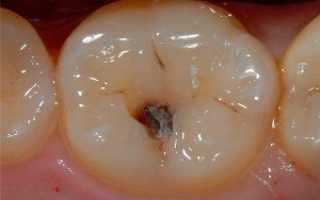 Как лечить острый очаговый пульпит: основные отличия от других форм заболевания и полезные советы стоматологов