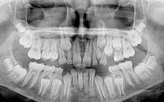 Ортопантомограмма или панорамный снимок зубов: цена и преимущества исследования, для чего проводится процедура