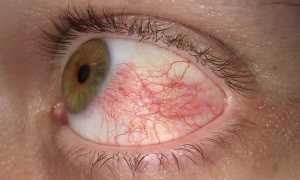 Офтальмопатия при тиреотоксикозе: симптомы и лечение глаз народными средствами