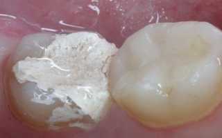 Для чего нужен мышьяк в зубе и сколько его можно держать без вреда для здоровья? Правила применения и возможные осложнения